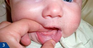 Прорезывание первых зубов у ребенка и сопутствующие симптомы