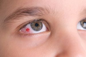 Аллергический конъюнктивит у детей симптомы и лечение