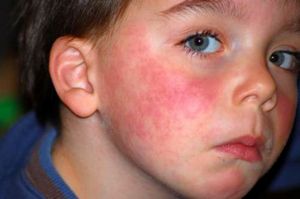 Аллергия у детей на молочные продукты
