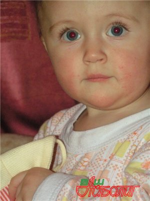 аллергия в паху у ребенка до года фото