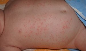 Аллергия в паху у ребенка до года фото
