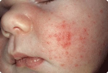 как выглядит аллергия на памперсы у ребенка фото