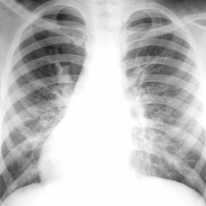 Симптомы туберкулеза у детей 7 лет