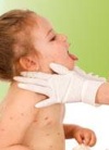 Воспаление лимфоузлов при ветрянке у детей