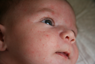 аллергия у 2 месячного ребенка на смесь