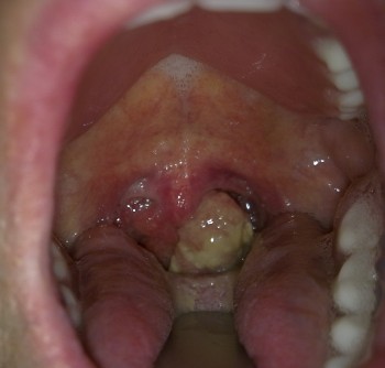 больное горло у ребенка лечение фото