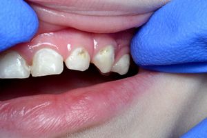 Лечение зубов детям 2 лет