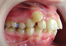 лечение зубов детям 2 лет