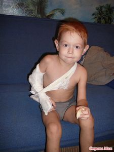 Перелом руки у ребенка фото