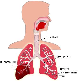 пневмония у детей симптомы форум