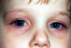 аллергический конъюнктивит у детей