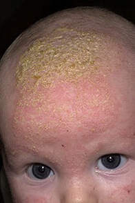 себорея на голове у ребенка лечение