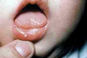 Ацикловир вирусный стоматит у детей