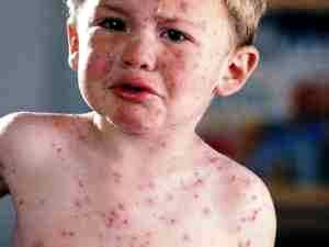 Аллергия на ацикловир у ребенка