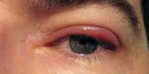 Аллергия на ацикловир у ребенка