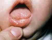 Герпетический стоматит у ребенка ацикловир