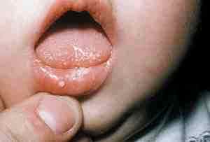 Лечение стоматита у ребенка ацикловиром