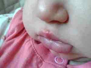 Ацикловир при герпесе на губах у ребенка