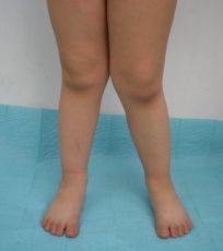 болезни тазобедренных суставов у детей