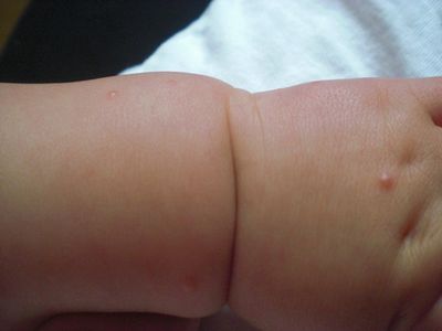 бронхит у ребенка 8 месяцев без температуры