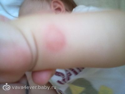 лечение укусов насекомых у детей