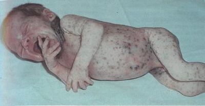 пневмония у детей фото рентген