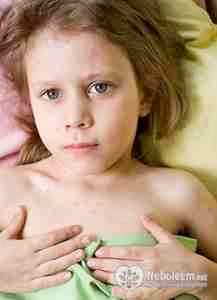 Ацикловир при лечении ветряной оспы у детей