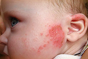 Аллергия на молоко у ребенка 2 года
