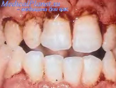 кариес постоянных зубов у детей особенности клинического течения