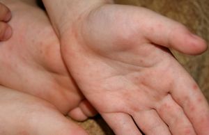Стоматит у детей на руках и ногах