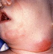 увеличенные миндалины у ребенка фото