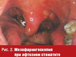 воспаление горла у детей комаровский